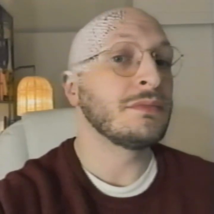 The same man with fine metal pins covering his scalp.